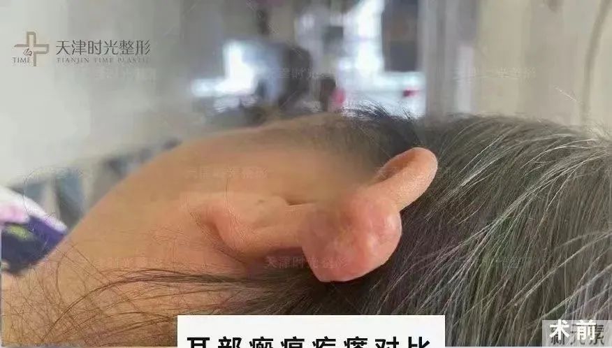 瘢痕疙瘩手术治疗后有痒痛感，什么问题? 图片-3
