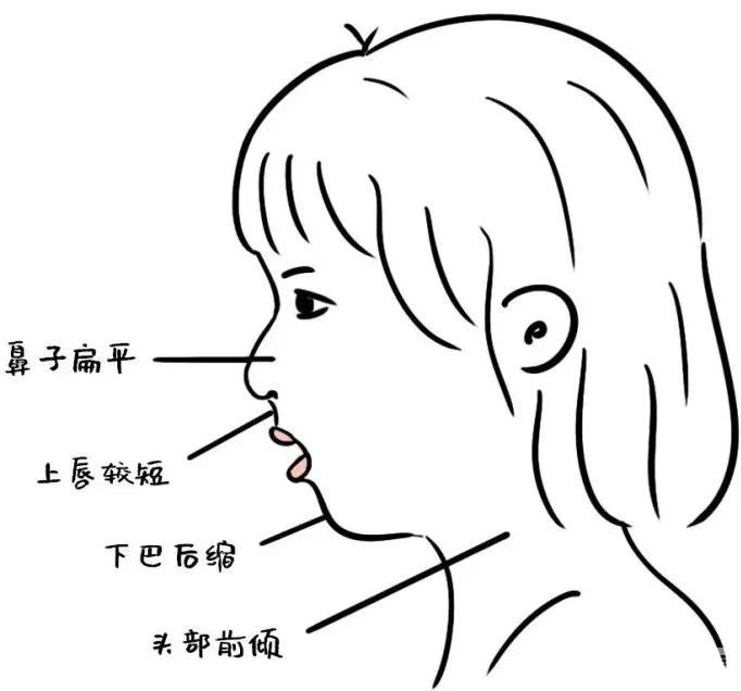 下巴后缩?需要分清是先天的还是后天的 图片-3