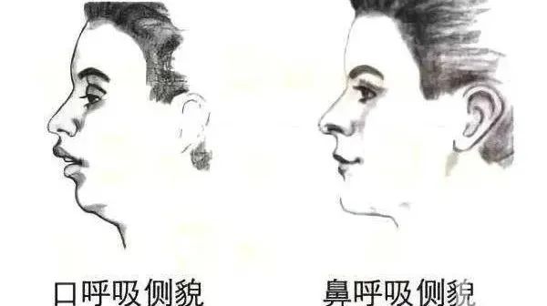 下巴后缩?需要分清是先天的还是后天的 图片-5