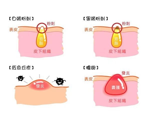 不同时期 的战痘经验 图片-1