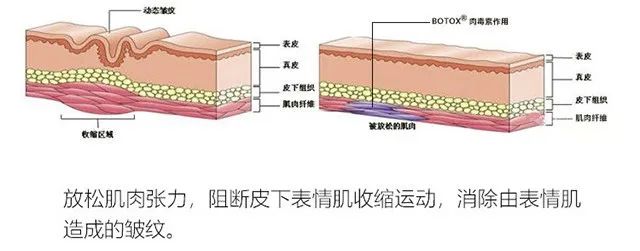 玻尿酸除皱与注射除皱有什么区别? 图片-6