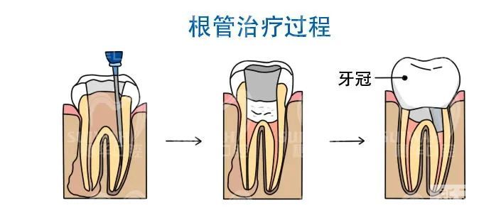 几百块到几千块，补牙真的越贵越好吗? 图片-8