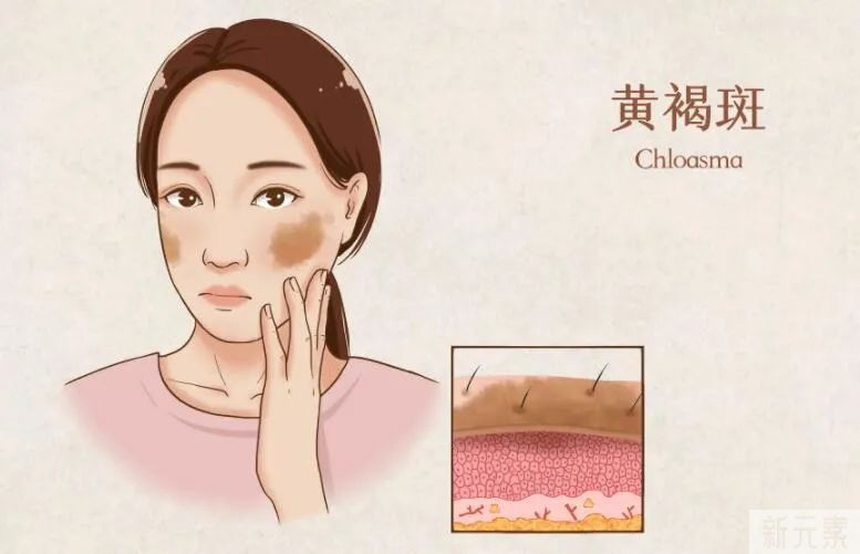 顽固黄褐斑怎么办?产后宝妈看过来，轻松美成蛋白肌! 图片-3