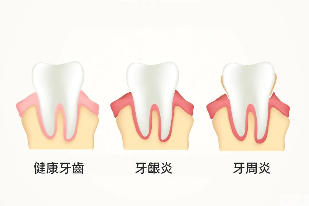 牙周炎可怕吗?不疼却一直在侵蚀牙齿?! 图片-3