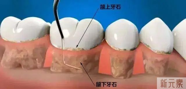 牙周炎可怕吗?不疼却一直在侵蚀牙齿?! 图片-4