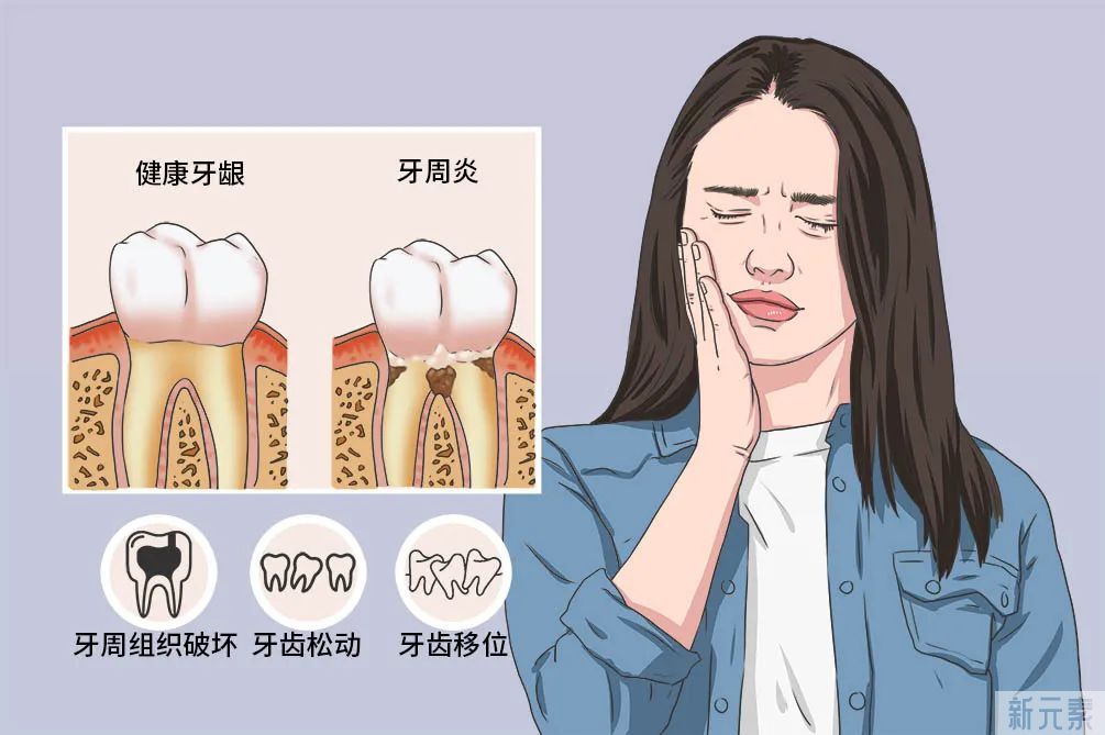 牙周炎可怕吗?不疼却一直在侵蚀牙齿?! 图片-5