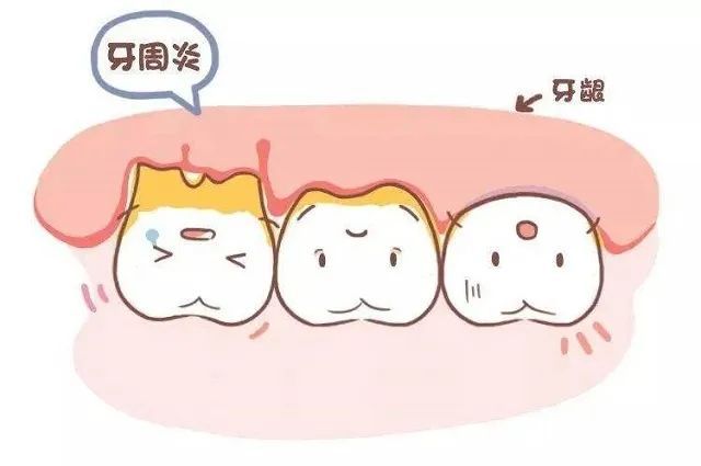 牙周炎可怕吗?不疼却一直在侵蚀牙齿?! 图片-2