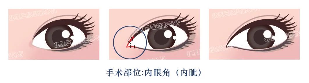 一次双眼皮手术可以同时改善哪些问题? 图片-3