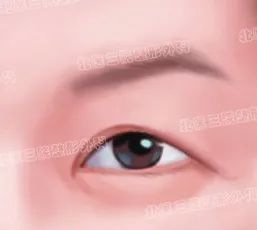 一次双眼皮手术可以同时改善哪些问题? 图片-2