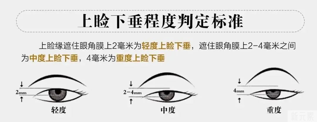 双眼皮和上睑下垂有什么关系? 图片-13