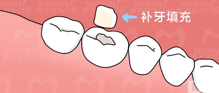 吃饭时补过的牙齿又崩了，这回还有得救吗? 图片-16