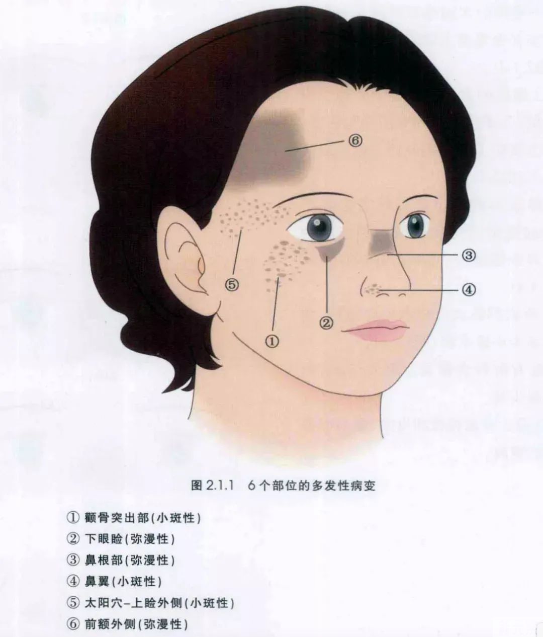 深层斑点和浅层色斑，治疗方法相同吗? 图片-8
