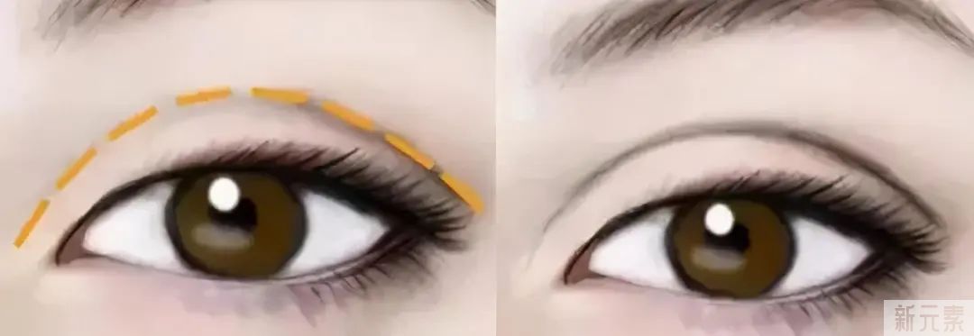 一个自然的双眼皮是多宽?3分钟看懂，不走弯路! 图片-5