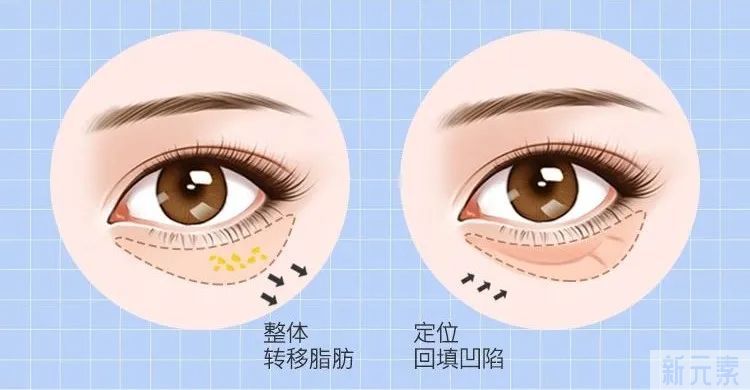 ​割了眼袋眼睛却凹陷了，这是咋个回事? 图片-9