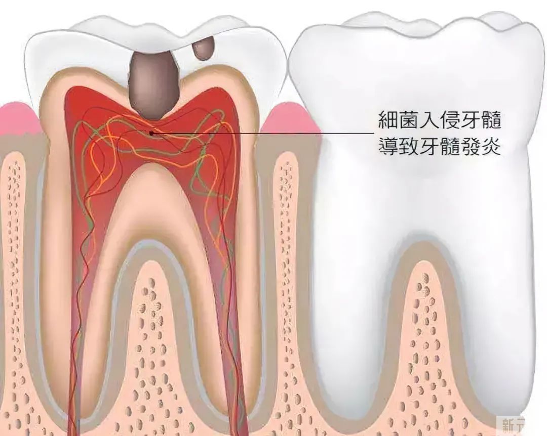 科普来了 | 听说牙痛含口冰水就能好? 图片-3
