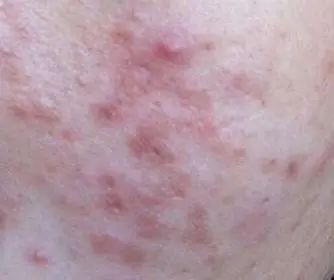 长青春痘会让人焦虑，家长别放任，早干预是关键 图片-1
