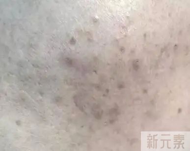 长青春痘会让人焦虑，家长别放任，早干预是关键 图片-6
