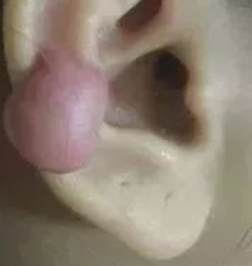 【打耳洞必看】打耳洞出现疤痕疙瘩，与这三个原因有很大关系! 图片-2
