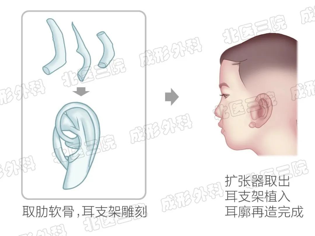 缺失的耳朵是怎么造出来的? 图片-3