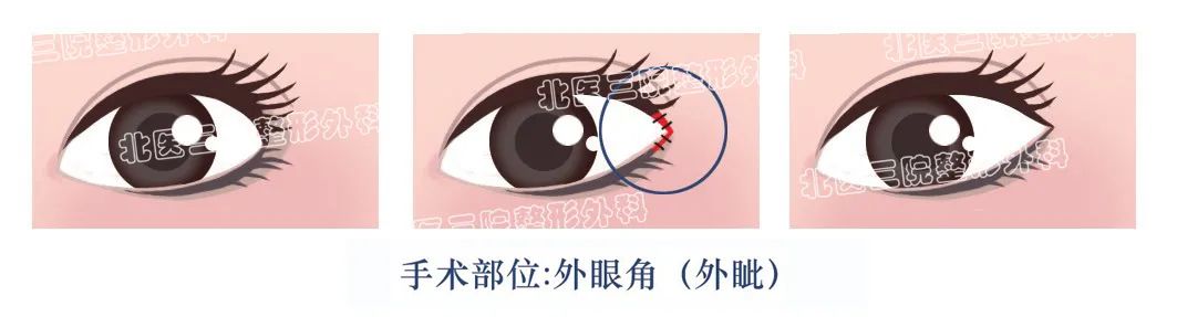 开眼角，怎么开? 图片-2