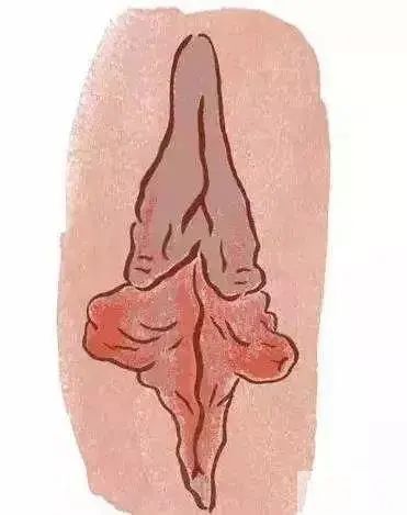 私处形态异常，小阴唇什么样才算正常? 图片-7