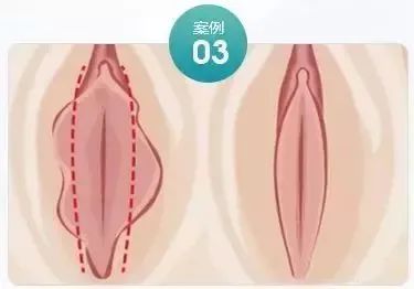 私处形态异常，小阴唇什么样才算正常? 图片-11