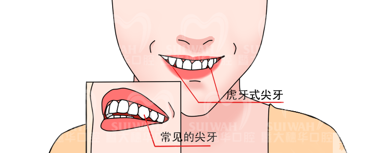 虎牙导致牙齿拥挤，医生却说千万不能拔? 图片-3