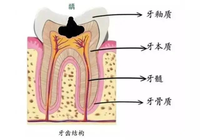 【名医说】为什么医生建议我先根管治疗而不是补牙? 图片-4