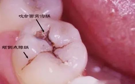 【名医说】为什么医生建议我先根管治疗而不是补牙? 图片-5