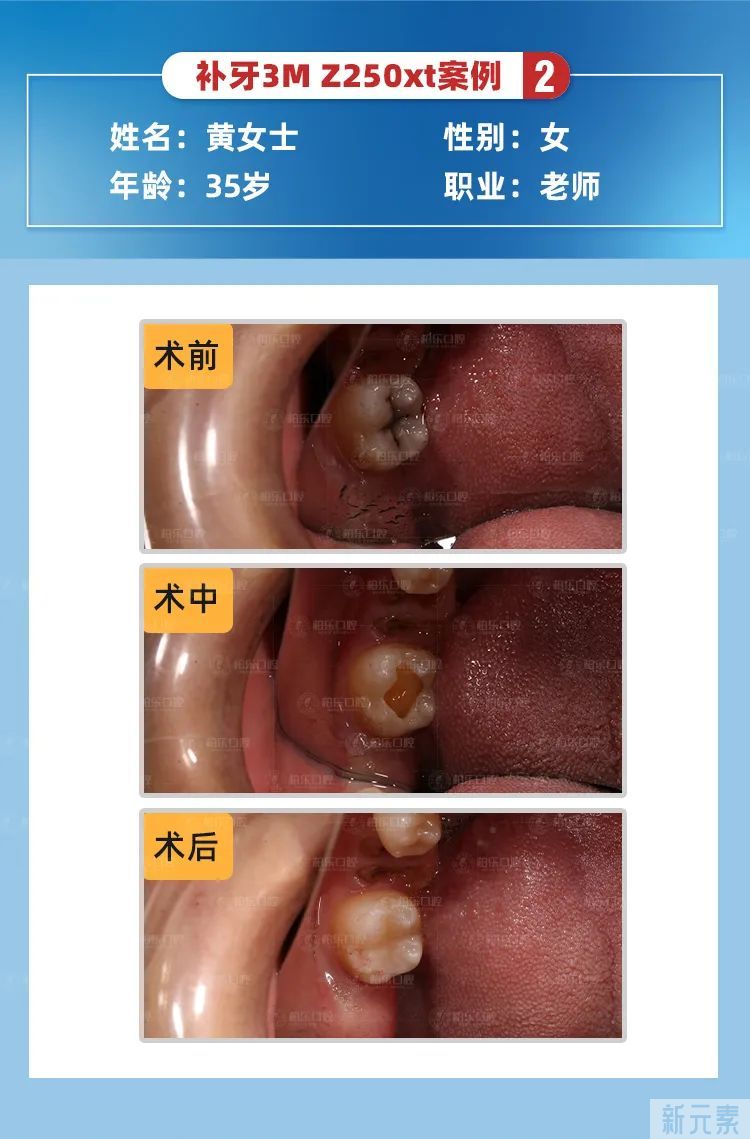 【名医说】为什么医生建议我先根管治疗而不是补牙? 图片-9