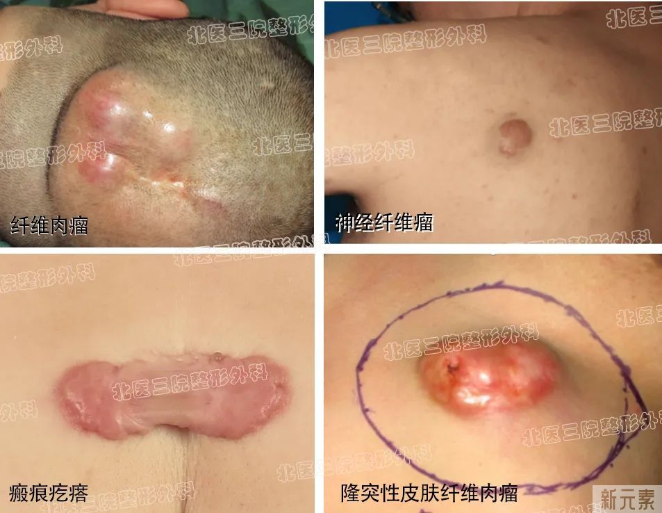 披着“瘢痕疙瘩”外衣的皮肤恶性肿物 图片-1