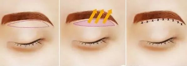 眼皮松松垮垮的,该做提眉还是割双眼皮? 图片-2