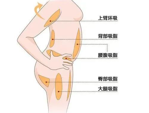 “躺瘦”指南 | 吸脂手术何时做?这个季节刚刚好! 图片-3