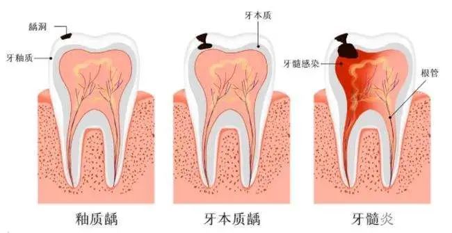 科普来了 | 揭秘牙痛种类和缓解疼痛妙招! 图片-8