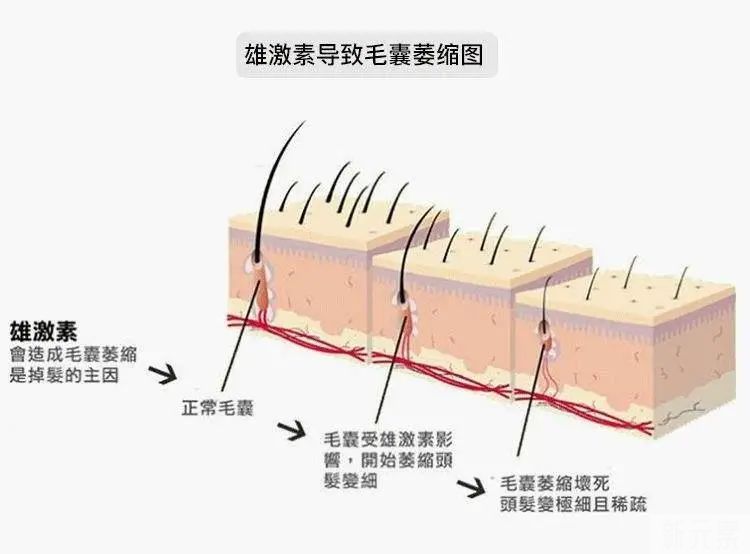 关于服用非那雄胺，你必须要知道的三大问! 图片-6