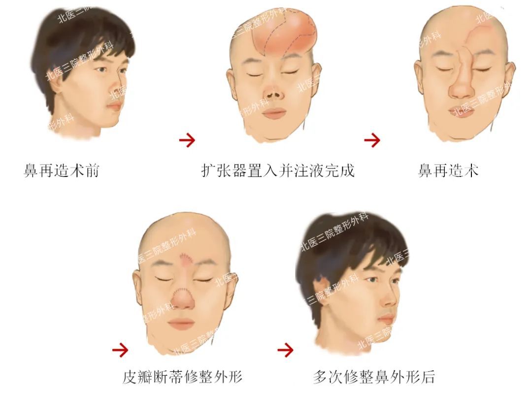 鼻子缺失，怎么再造一个新鼻子? 图片-1