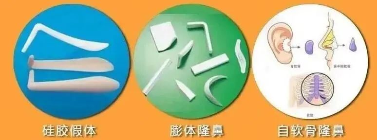 隆鼻失败的4大原因找到了!初鼻小白速来避坑! 图片-4