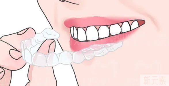 戴隐形牙套之前，你最想知道的5件事 图片-3