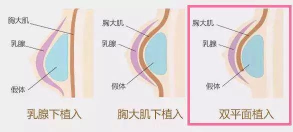选择假体隆胸你将会经历哪些? 图片-2