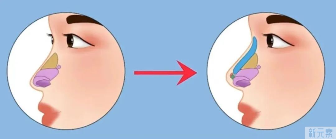 一次隆鼻可以管永久?明星砸钱不停返工却是为何? 图片-3