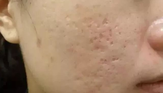 不同类型凹陷疤的修复方法，你一定要知道! 图片-3