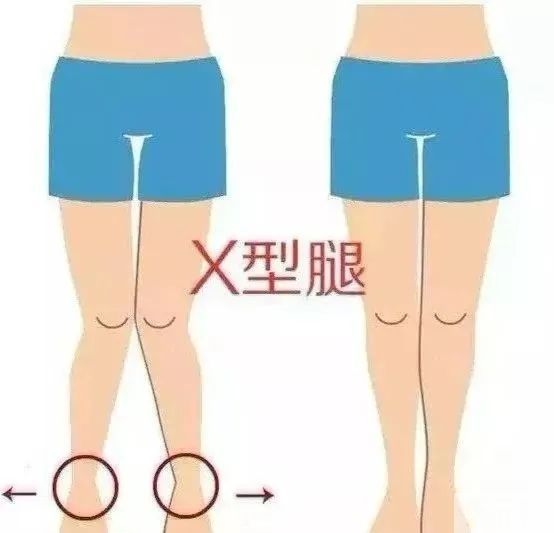 有什么办法能矫正腿型? 图片-7