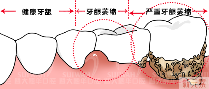 医生!我的牙龈萎缩了，能再恢复吗? 图片-5