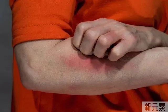 疤痕变黑怎么办?怎么做才有效去黑? 图片-8