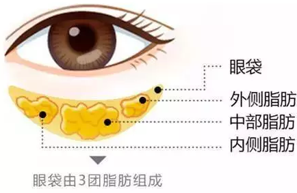 20岁不急做眼袋?40岁担心效果?到底几岁治疗眼袋好? 图片-1