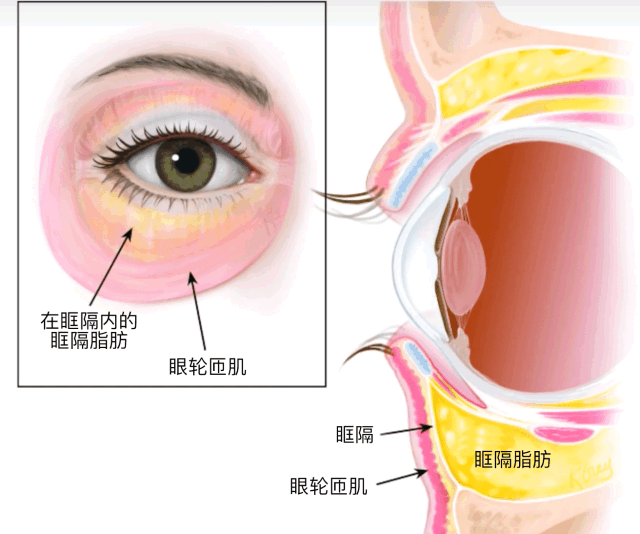 20岁不急做眼袋?40岁担心效果?到底几岁治疗眼袋好? 图片-2