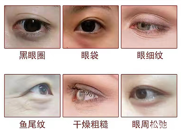 黑眼圈、眼袋、眼纹等眼周问题，保养的关键在哪里? 图片-2