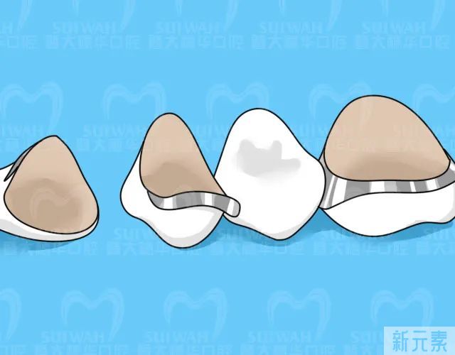 根管治疗后，关于牙冠的这些问题你应该知道 图片-6