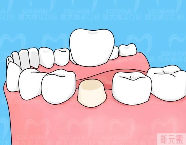 根管治疗后，关于牙冠的这些问题你应该知道 图片-7