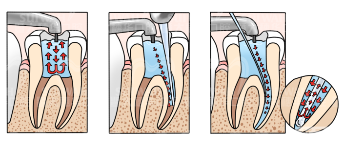 根管治疗后，关于牙冠的这些问题你应该知道 图片-3